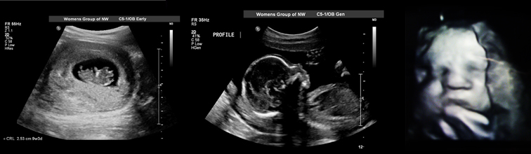 us obstetric dating scan