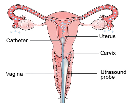 Illustration of FemVue procedure