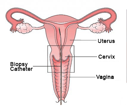 Illustration of an endometrial biopsy