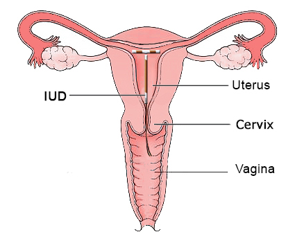 Illustration of a IUD in the Uterus