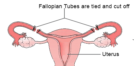 illustration of a tubal ligation